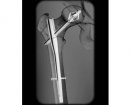 x-bolt femoral nail.jpg